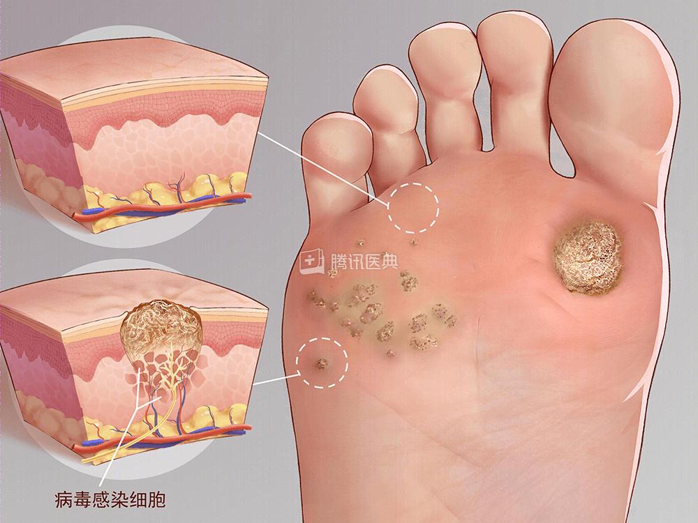 补硒能治瘊子吗