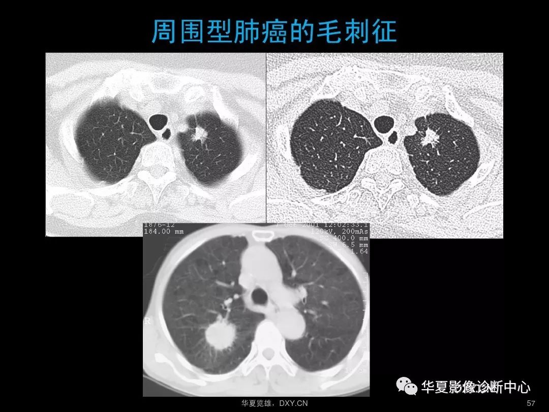 硒维康抗肺癌吗