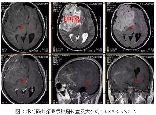 硒维康对胶质瘤