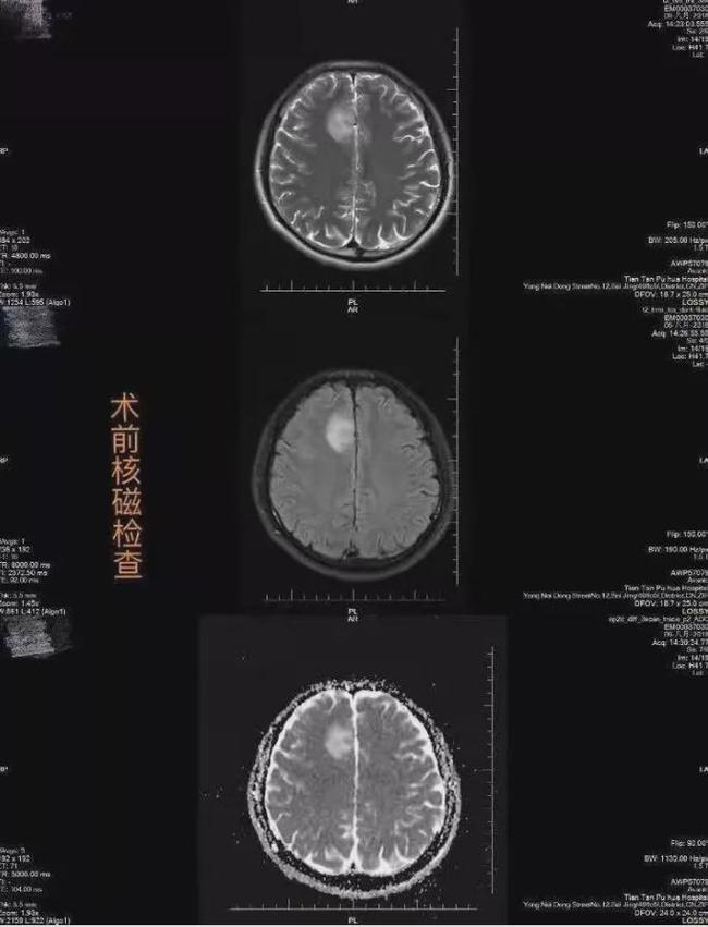 硒维康对胶质瘤