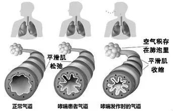 哮喘补硒元素