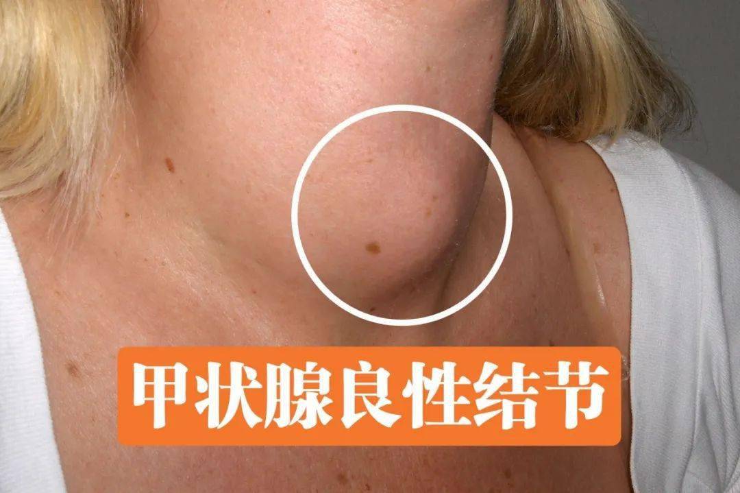 甲状腺能吃补硒吗