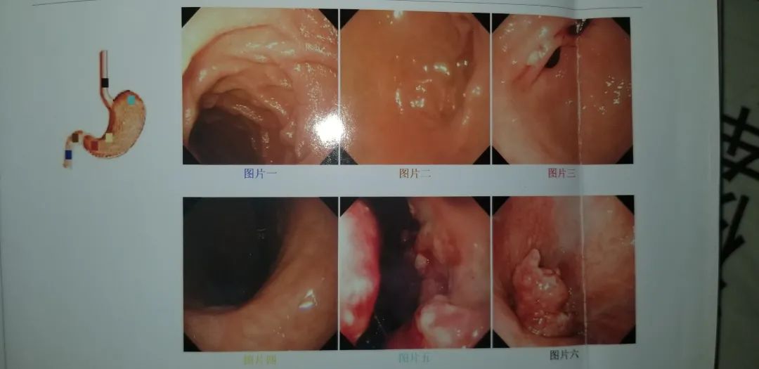 胃癌术后怎样补硒