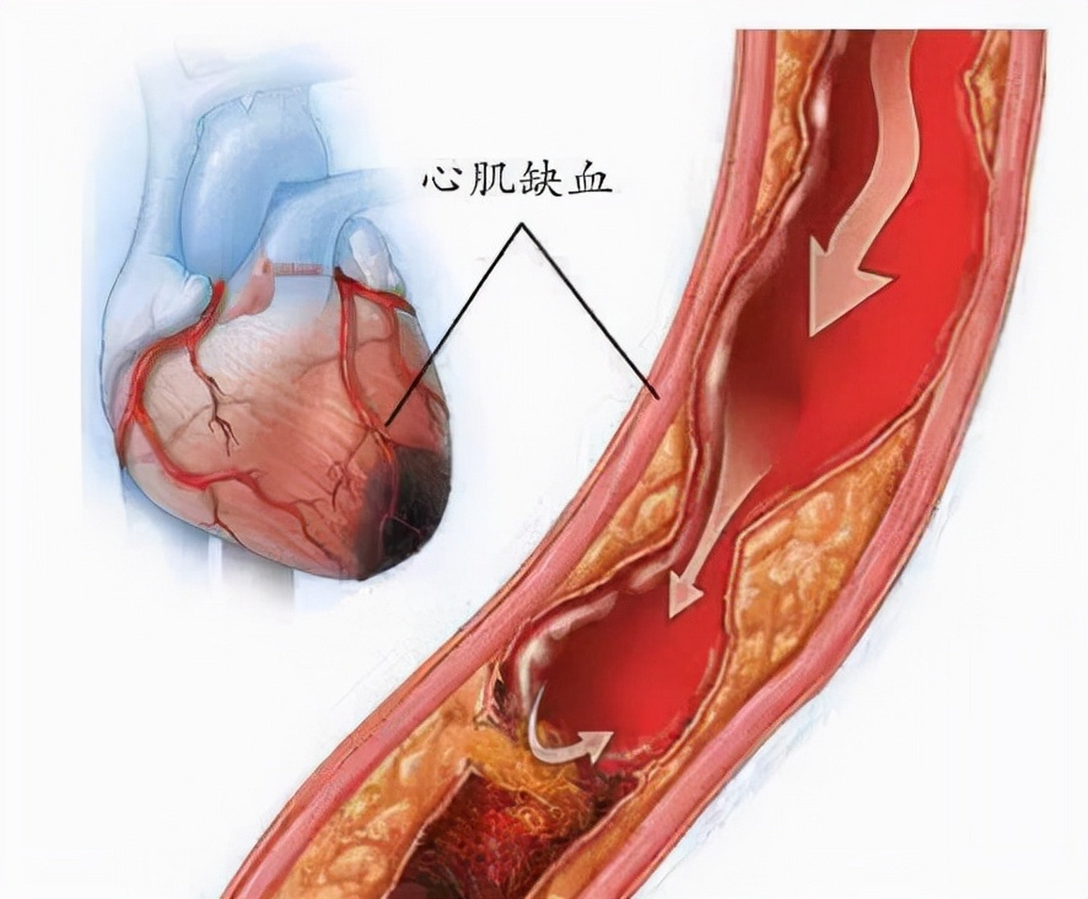 桥本甲亢补硒用药