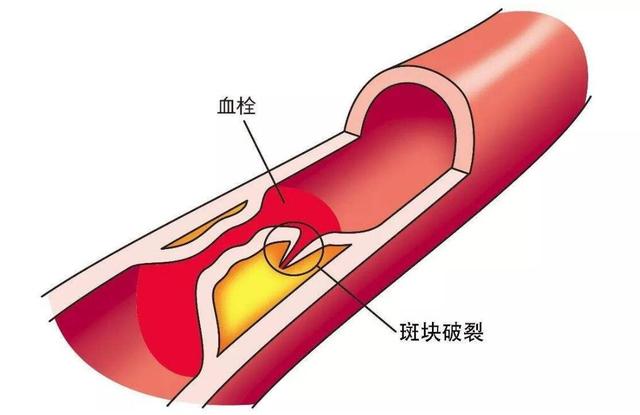 补硒造成血压降低