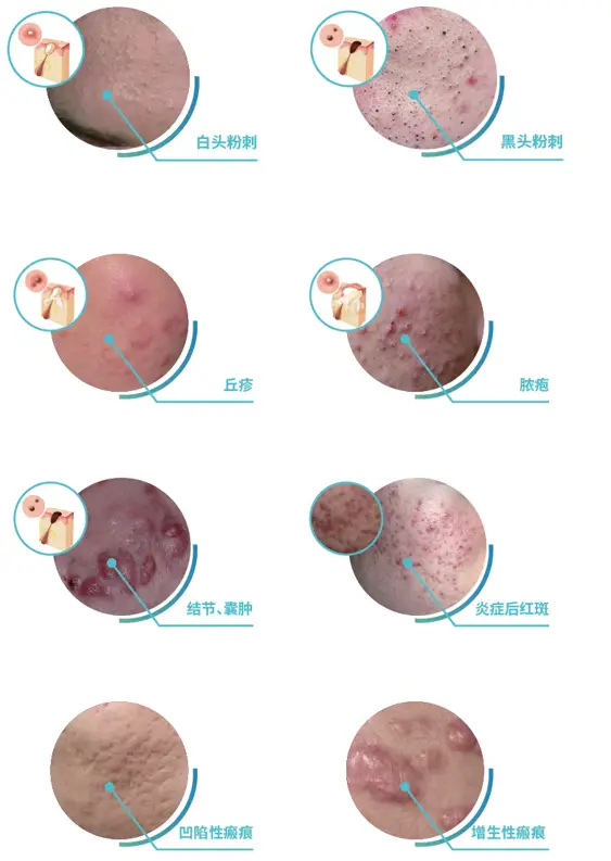 补硒后脸上起痘痘