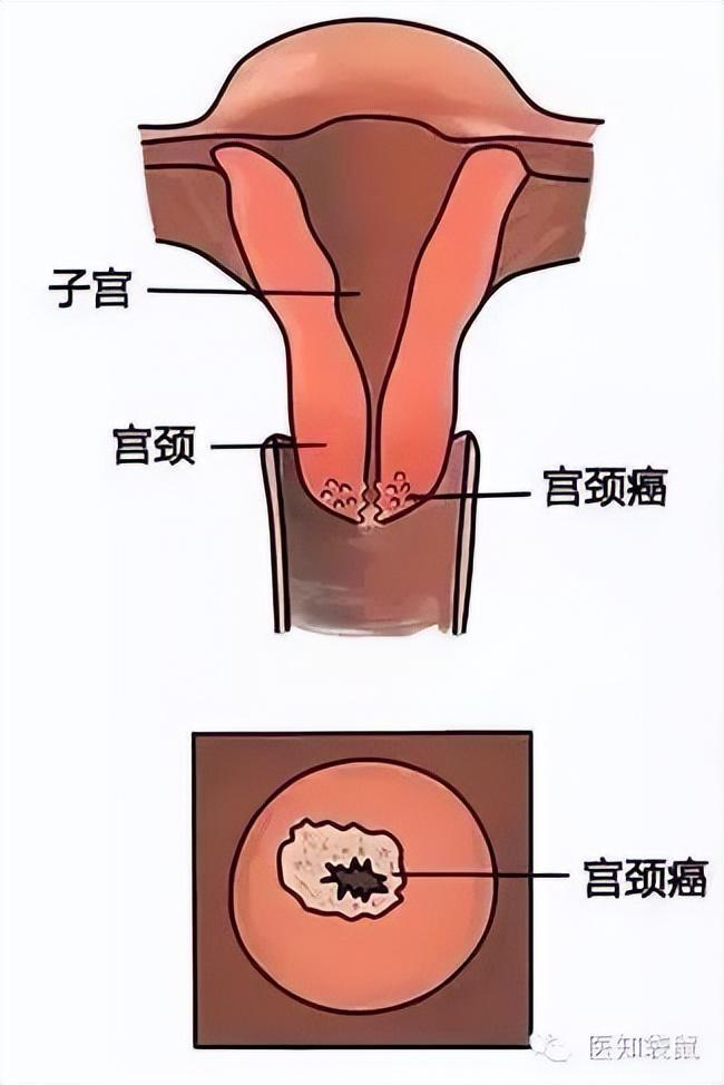 补硒治疗癌前病变