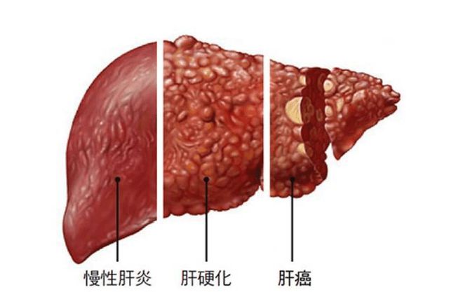 肝病为什么要补硒