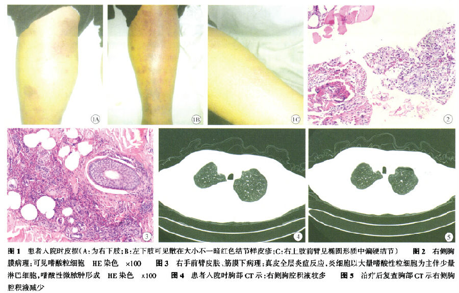 狼疮肾炎可补硒吗