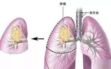 肺癌病人怎么补硒