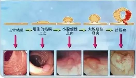 补硒对肠息肉好处