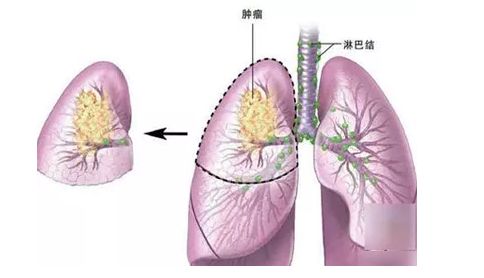 肺癌病人怎么补硒