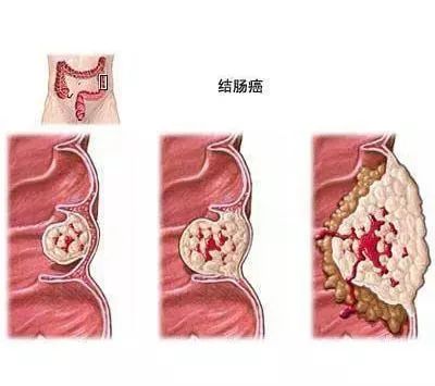 补硒对肠息肉好处