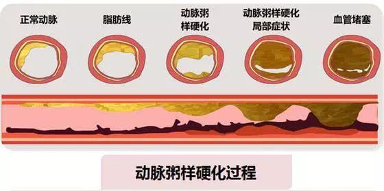 脑梗病人能补硒吗