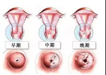 补硒预防宫颈癌吗