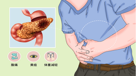 胰腺癌晚期补硒吗