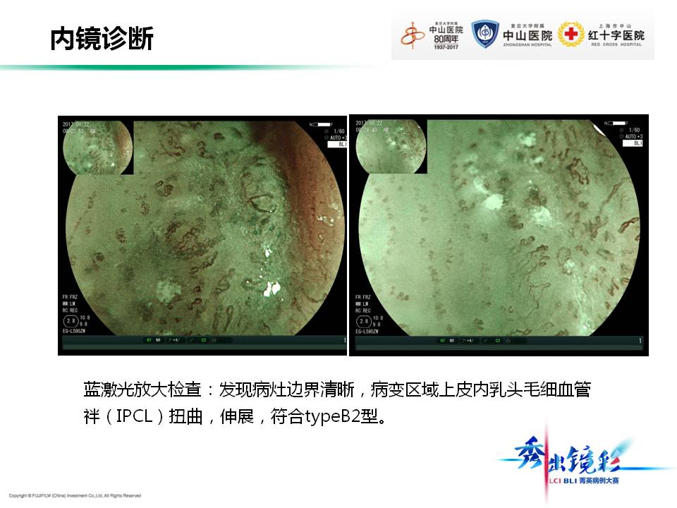 食道癌大剂量补硒