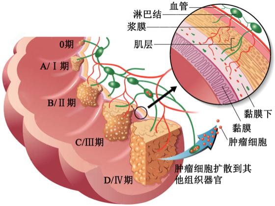 直肠癌可以补硒吗