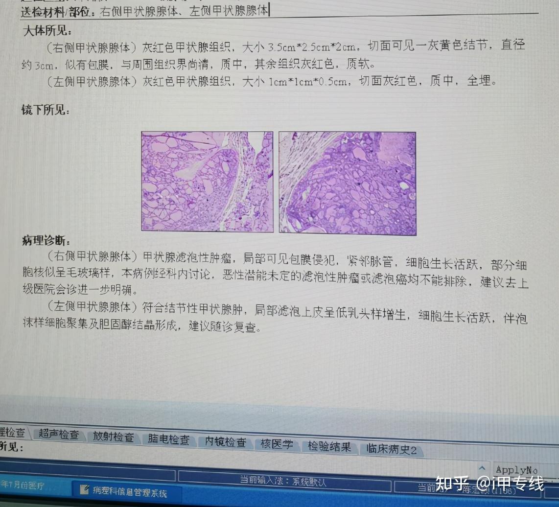 甲亢病补硒有用吗