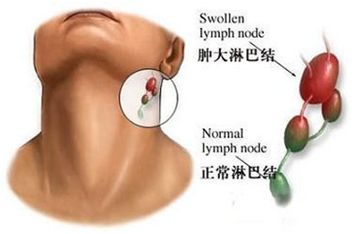 糖尿病胆囊癌补硒