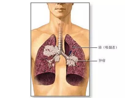 肺结核病能补硒吗