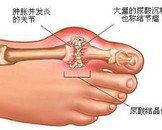 富硒茶治疗痛风吗