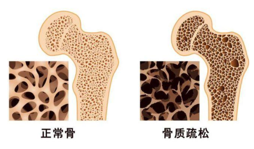 正确补钙的方法