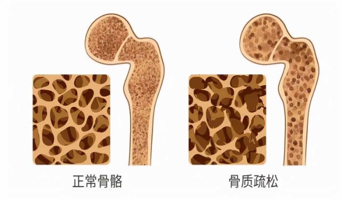 骨质增生能不能补钙