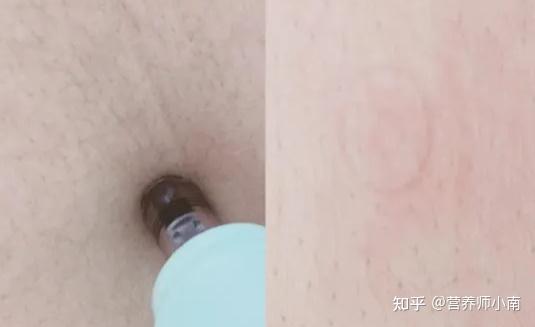 锌硒宝蛋白锌过敏