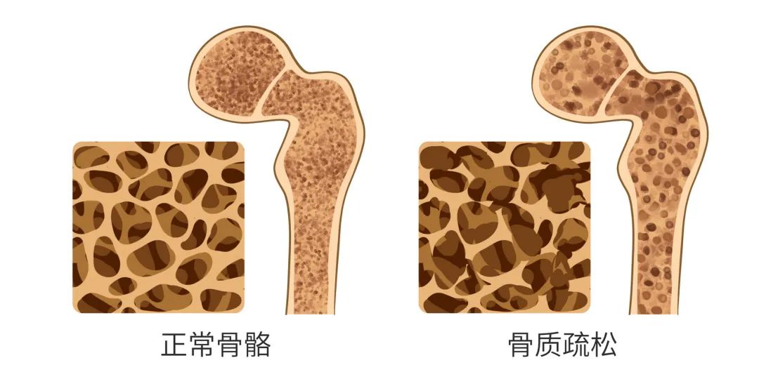 更年期如何补钙