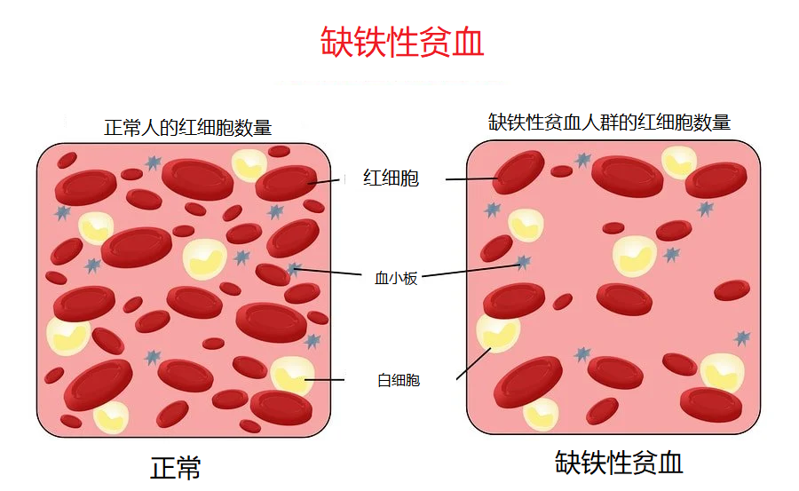 怎么补铁蛋白