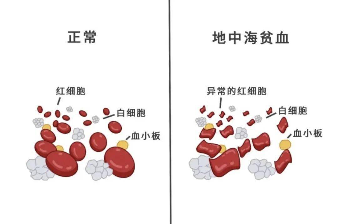 地贫不能补铁