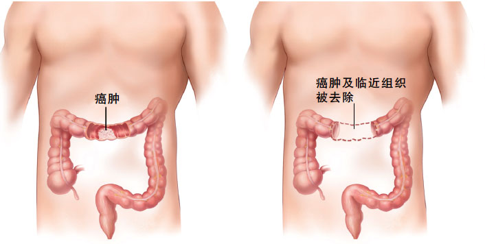 肠癌晚期补硒的危害