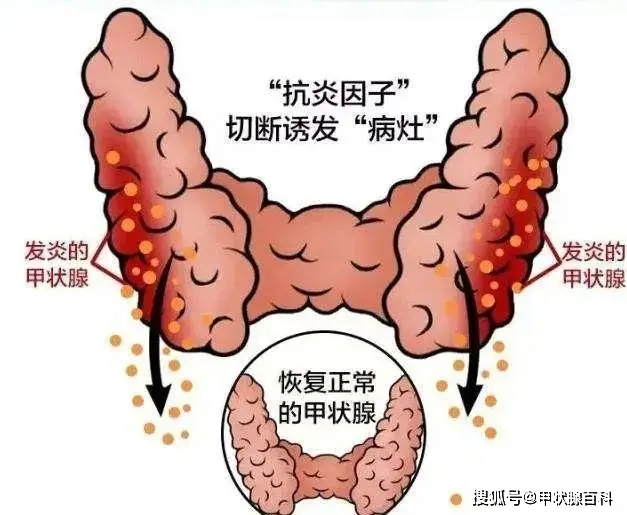 甲状腺结节补硒好吗