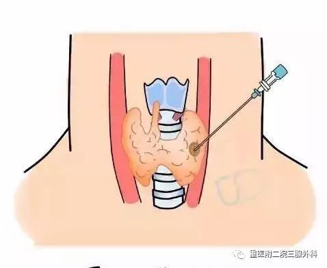 甲状腺结节补硒行吗