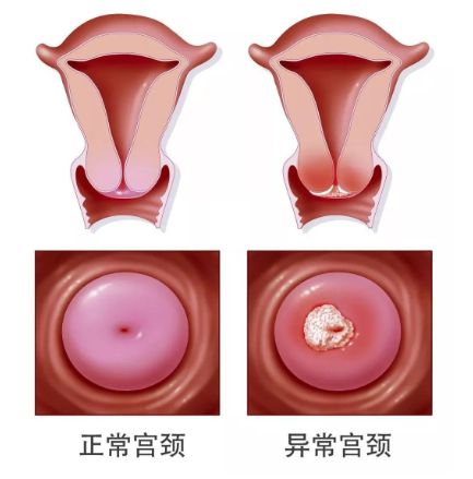 补硒用量hpv患者