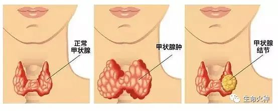 甲状腺结节怎么补硒