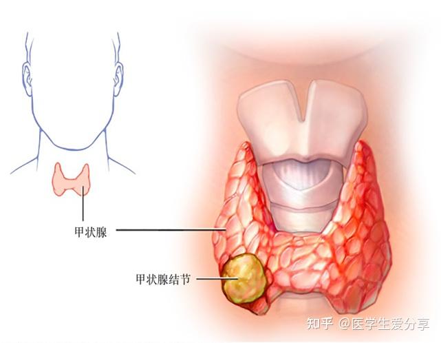 甲状腺结节补硒剂量