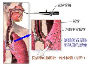 活检病变补硒的目的