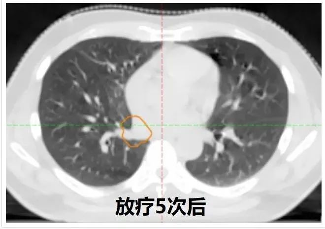 肺癌手术后不能补硒