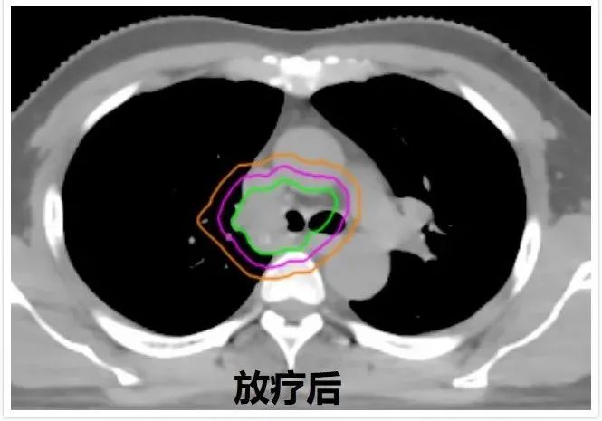 肺癌手术后不能补硒