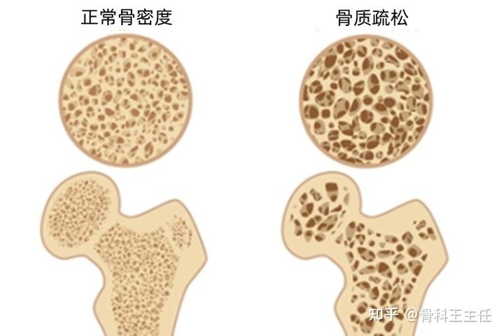 骨质疏松吃什么钙片补钙最好