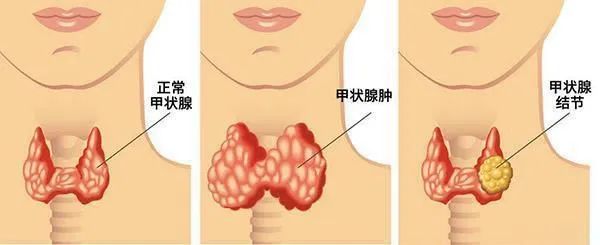 甲状腺结节要补硒吗