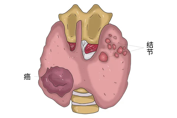 甲状腺结节要补硒吗