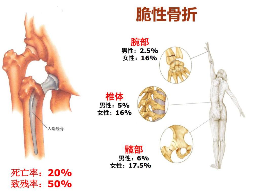 有补钙的针剂吗