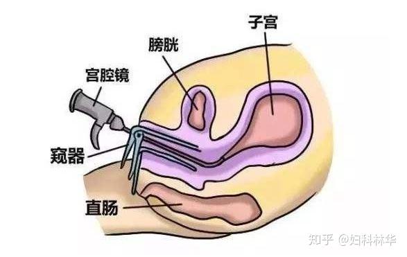 子宫肌瘤需要补硒嘛