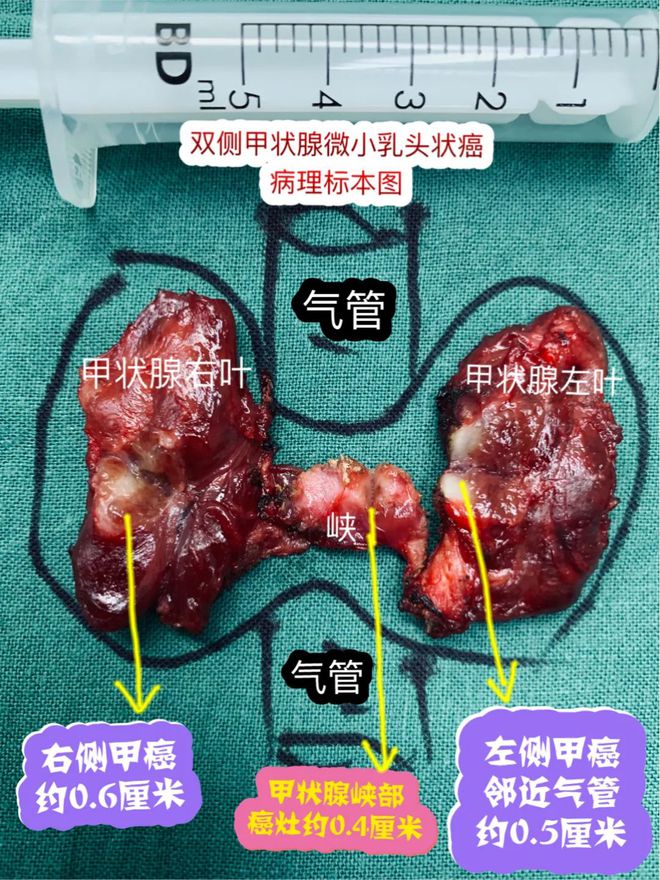 补硒能让肿块缩小吗