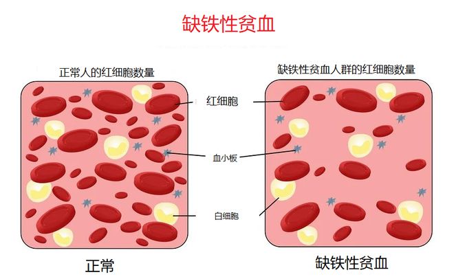 孕早期可以补铁吗