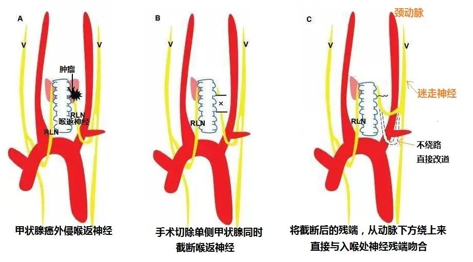 甲状腺癌术后 补硒