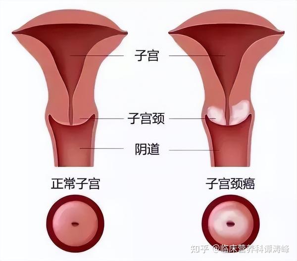 宫颈癌病人怎么补硒